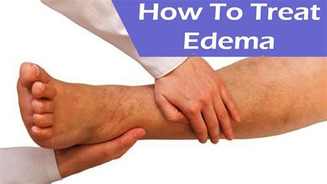 Edema: Types, Causes, Symptoms, and Treatment